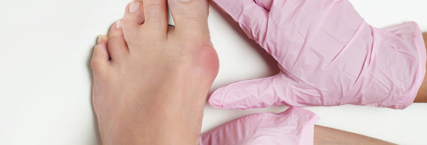 hallux valgus